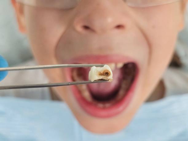 Best Emergency Treatment for Dental Infections or Abscesses in Cumberland Hill, RI